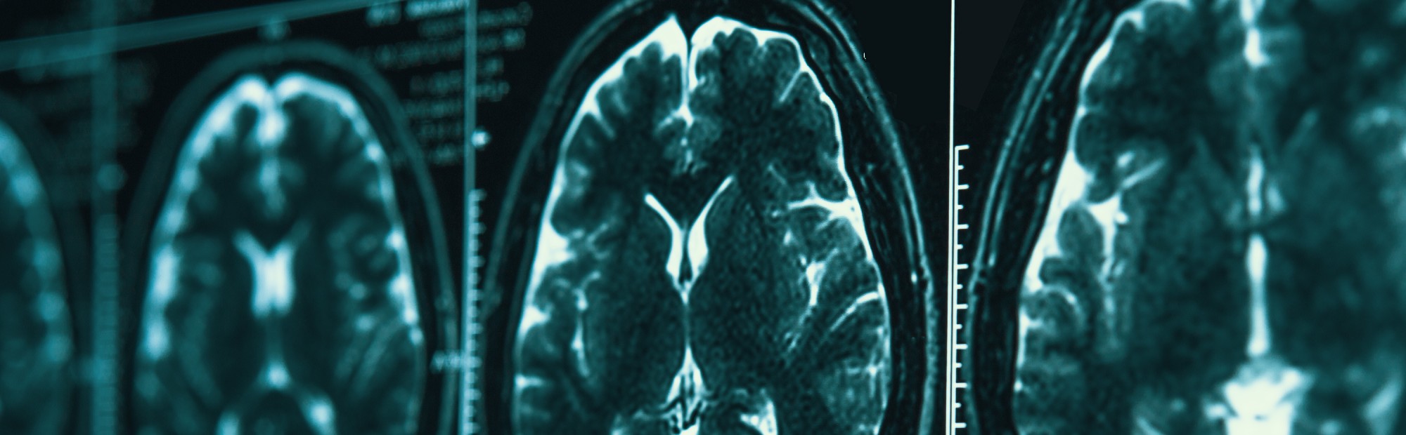MRI brain scan images
